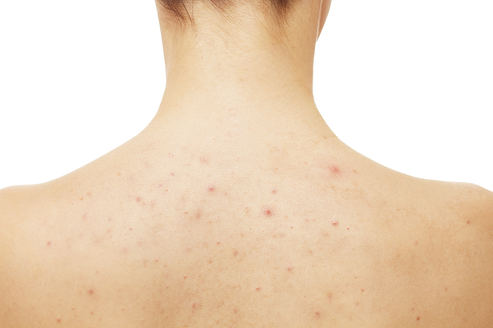 Image showing back acne