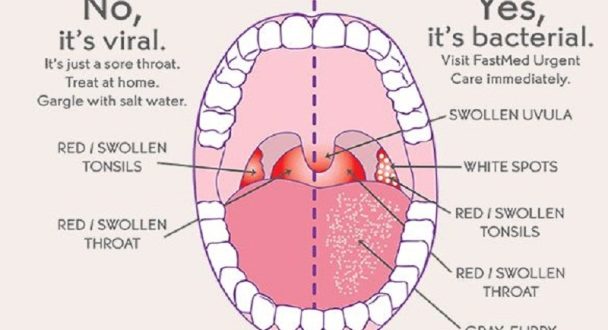 can-you-get-strep-without-tonsils-archives-the-right-news-network